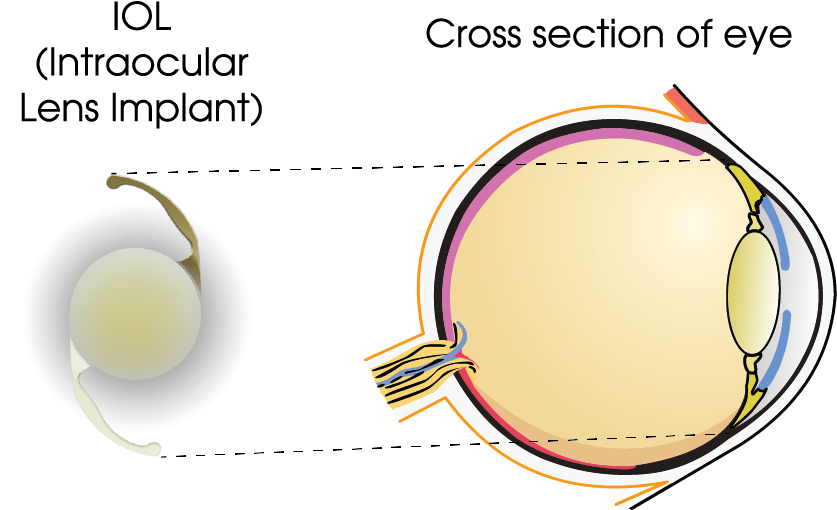 Once Implanted, With The Aid Of Advanced Technology, - Portable Network Graphics (836x519)