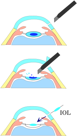 Surgical Technique[edit] - Phacoemulsification Adalah (300x470)