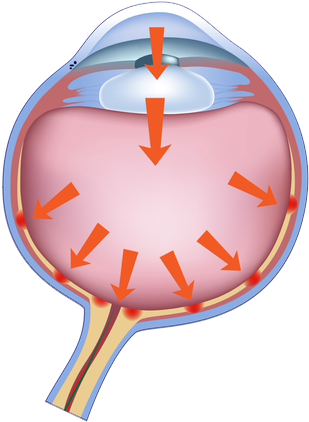 A Sustained Fluid Pressure On The Optic Nerve Of The - Glaucoma (318x467)