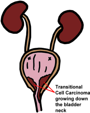 Urinary Tract With A Transitional Cell Carcinoma Growing - Transitional Cell Carcinoma Adalah (297x417)