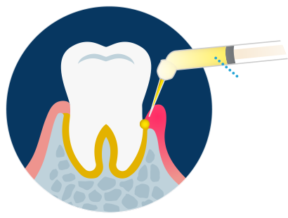 Guidor Periocline Dental Ointment - Cartoon Periodontal Regeneration (420x310)