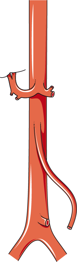 Download The Image - Abdominal Aortic Aneurysm (271x912)