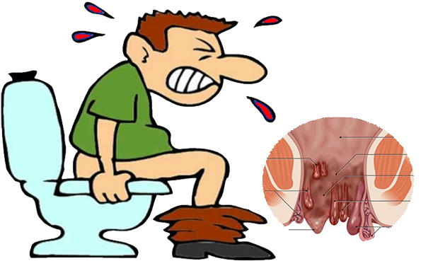 One Of The Best Ayurvedic Medicine For Piles Available - Chronic Constipation (607x368)