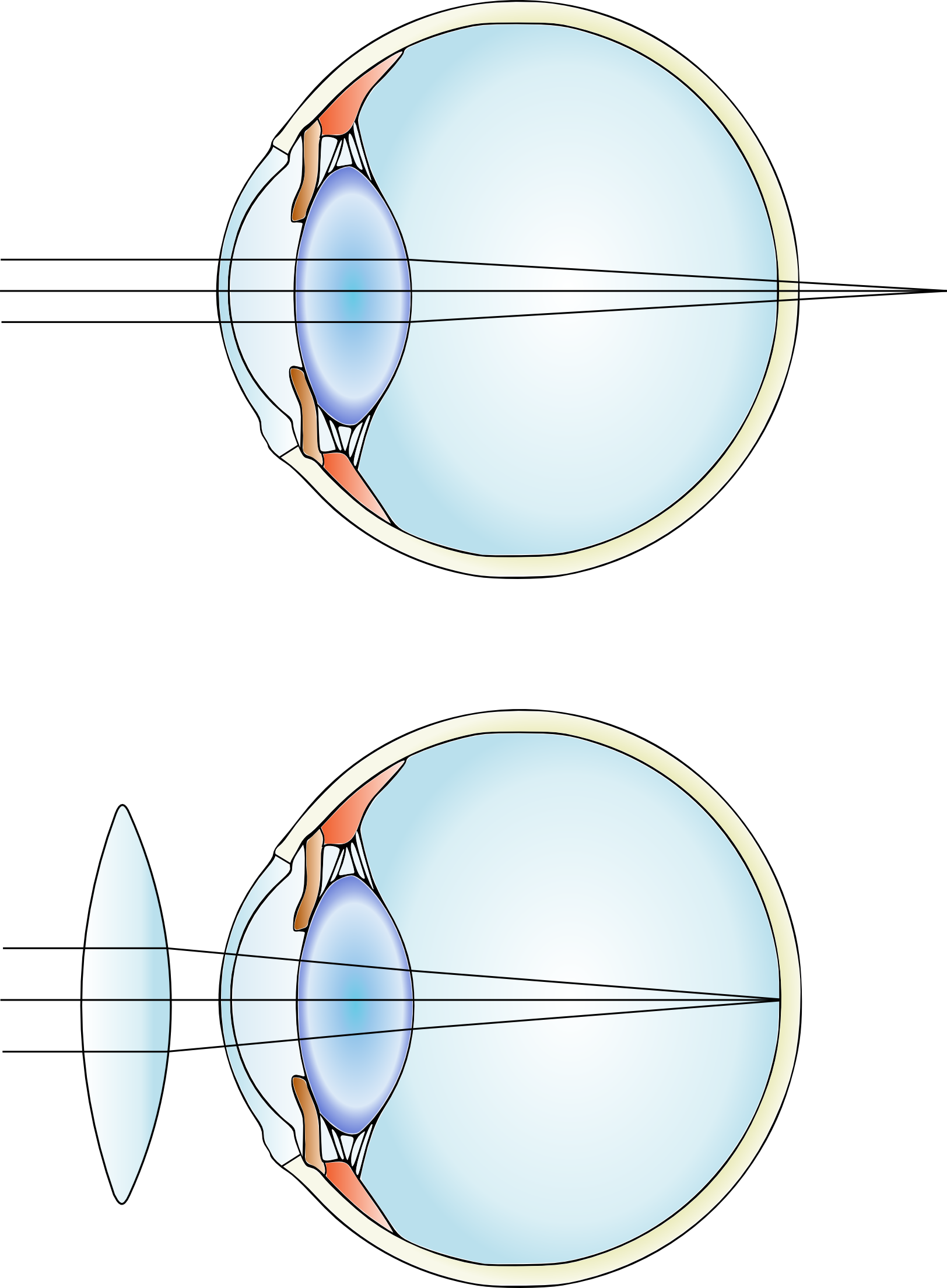 #physics117 Corrective Lenses Help The Eye Create An - Far-sightedness (1624x2209)
