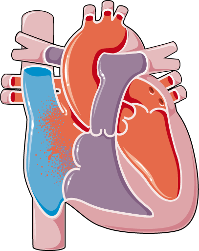 Congenital Heart Diseases Atrial Septal Defect - Ventricular Septal Defect (407x511)