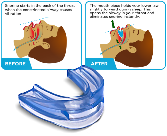 Anti-snoring - Mouth Guard For Snoring (640x520)