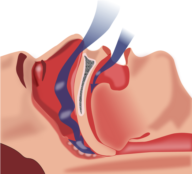 Illustration Of Obstruction Of Ventilation - Cpap Treatment For Obstructive Sleep Apnea (1069x1024)