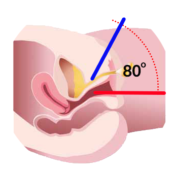 Test Q-tip - Q Tip Test Incontinencia Urinaria (394x394)