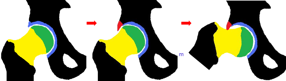 “cam Impingement” Occurs When A Non Spherical Femoral - “cam Impingement” Occurs When A Non Spherical Femoral (1000x283)