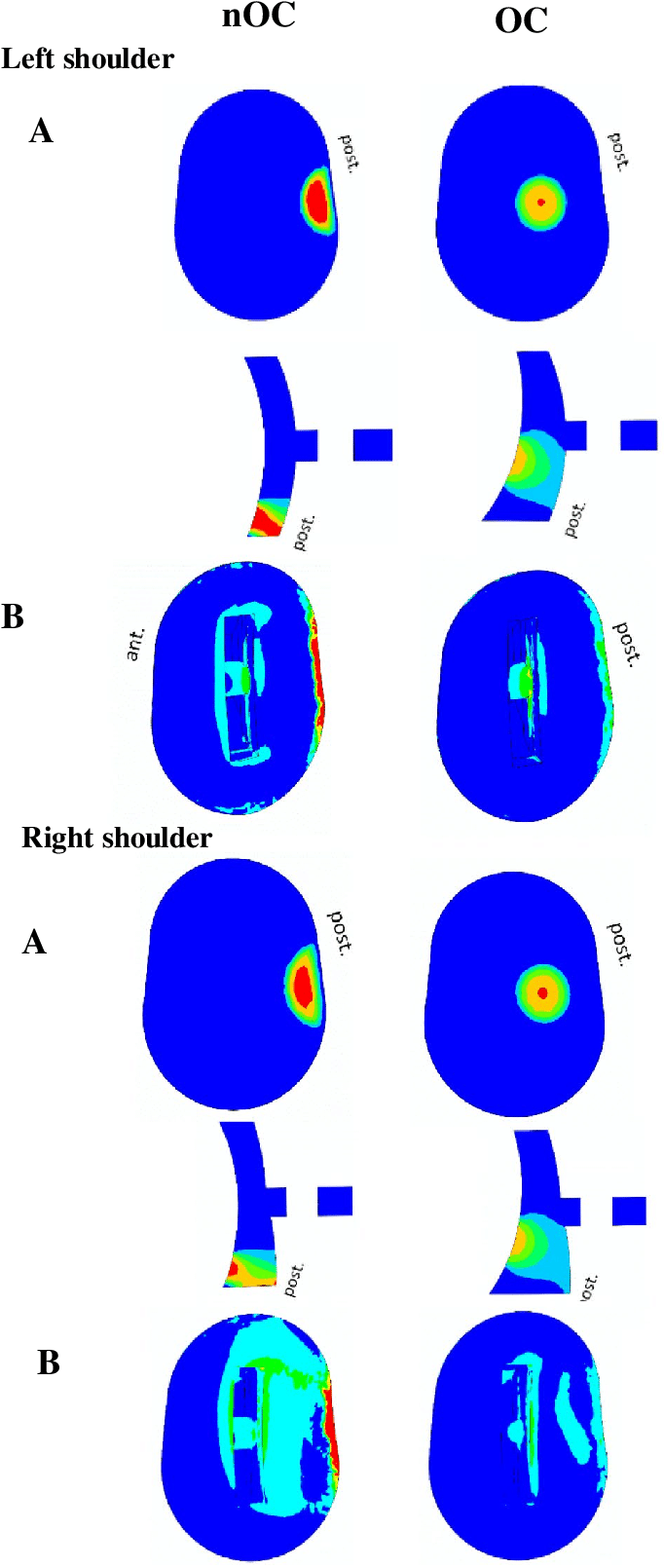 Maximum Principal Stress On Glenoid Implant For Left - Circle (707x1614)