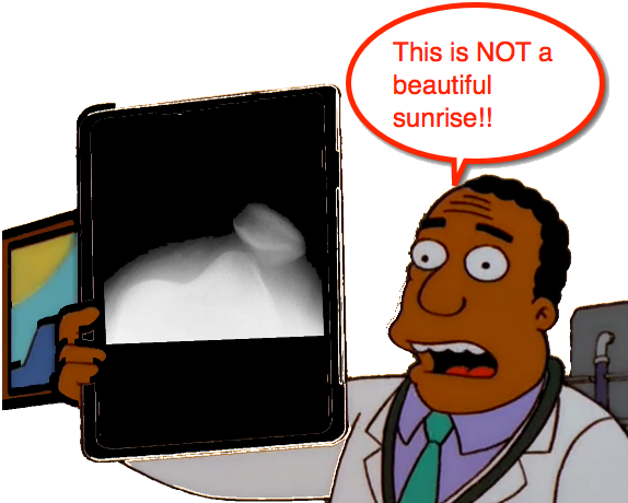 Patellar Dislocation - Reduction Of Patellar Dislocation (574x460)