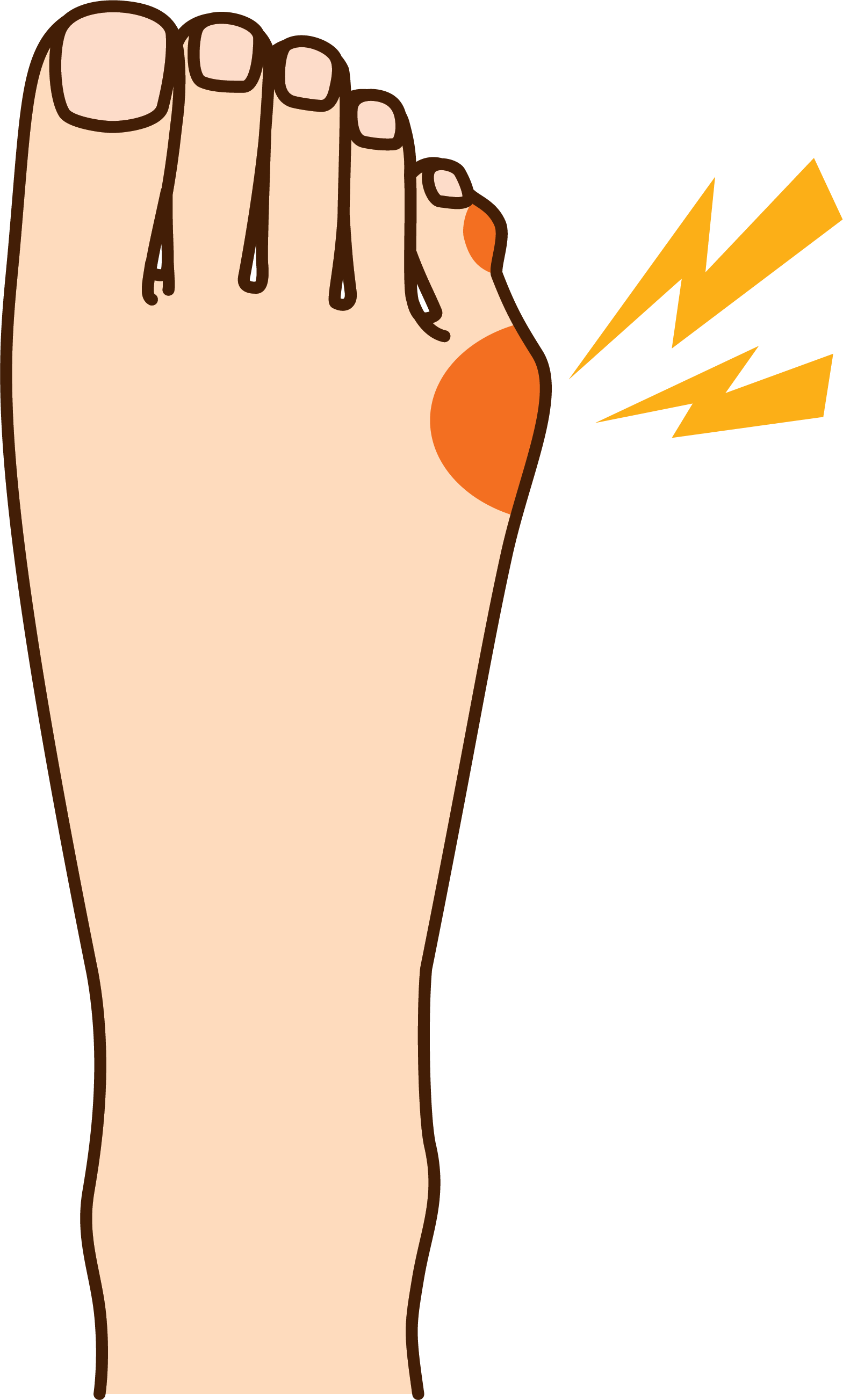 How To Relieve Your Tailor's Bunion Pain - How To Relieve Your Tailor's Bunion Pain (1569x2607)