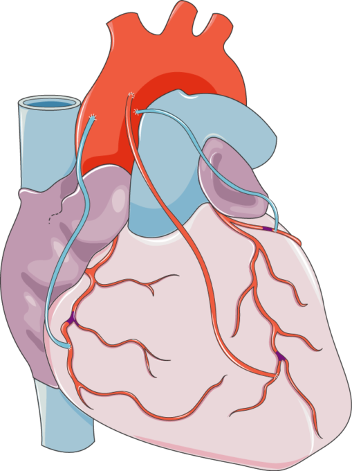Coronary Artery Bypass Grafting - Bypass Surgery (509x680)