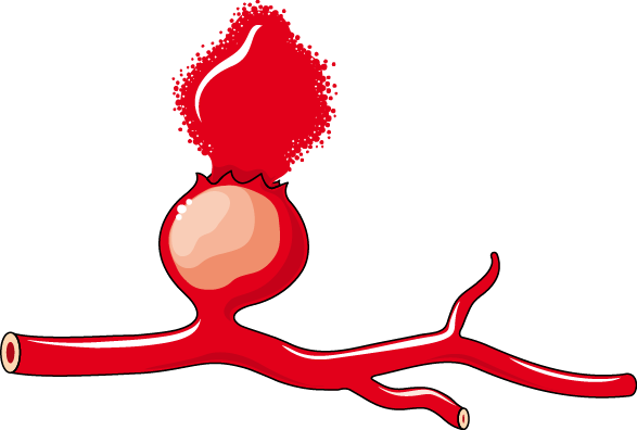 Download The Image - Aneurysm (587x396)