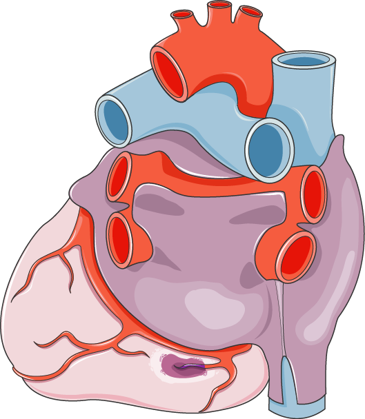Download The Image - Schéma D Un Infarctus (529x608)