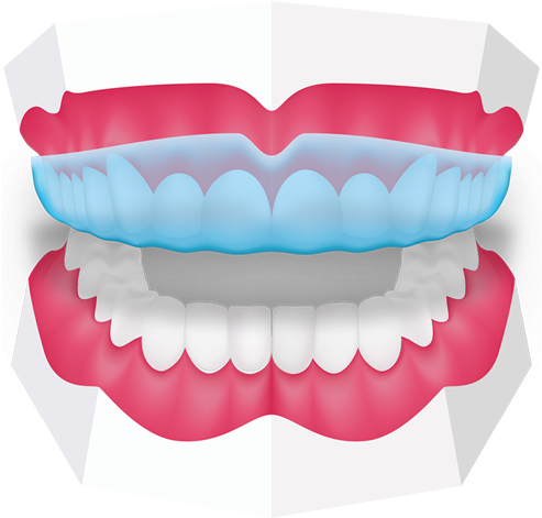 Mouthguards At Toothbeary - Orthodontics (500x485)