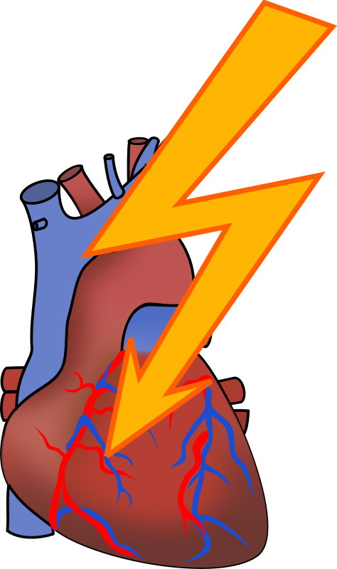 Clipart - Heart Attack - Heart Attack Clip Art (474x800)