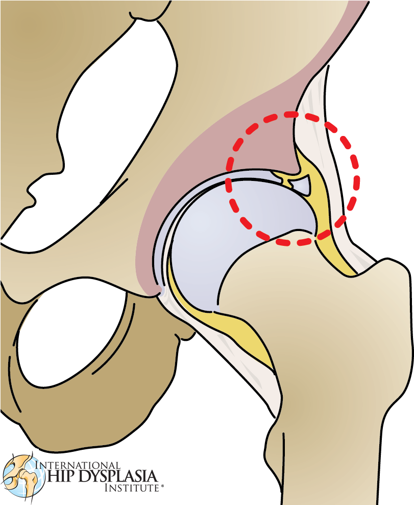 Torn Labrum Illustration [ ] Enlarge - Hip Dysplasia Labral Tear (841x987)