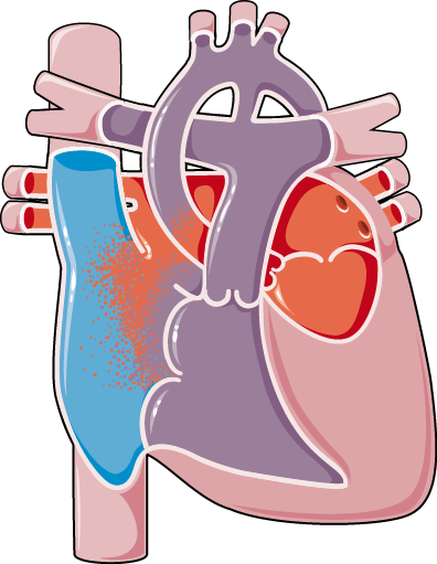 Congenital Heart Disease Hypoplastic Left Heart Syndrom - Birth Defect (396x511)