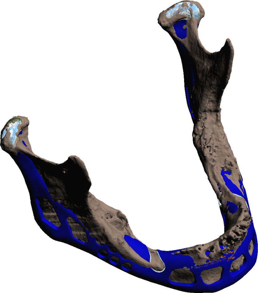 Psi Design - Full Jaw Implant (834x949)