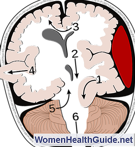 การเพิกถอนสมอง - Hernias - Brain Herniation (451x490)