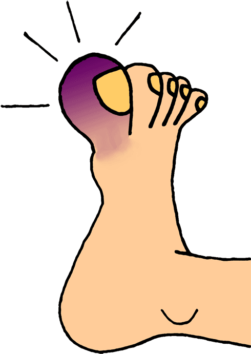 Broken Foot Cartoon - Toe Clip Art (500x706)