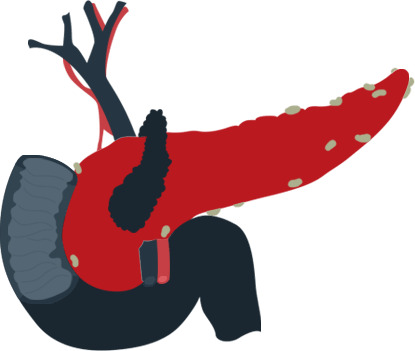 Pancreatic Cancer - Illustration (415x351)