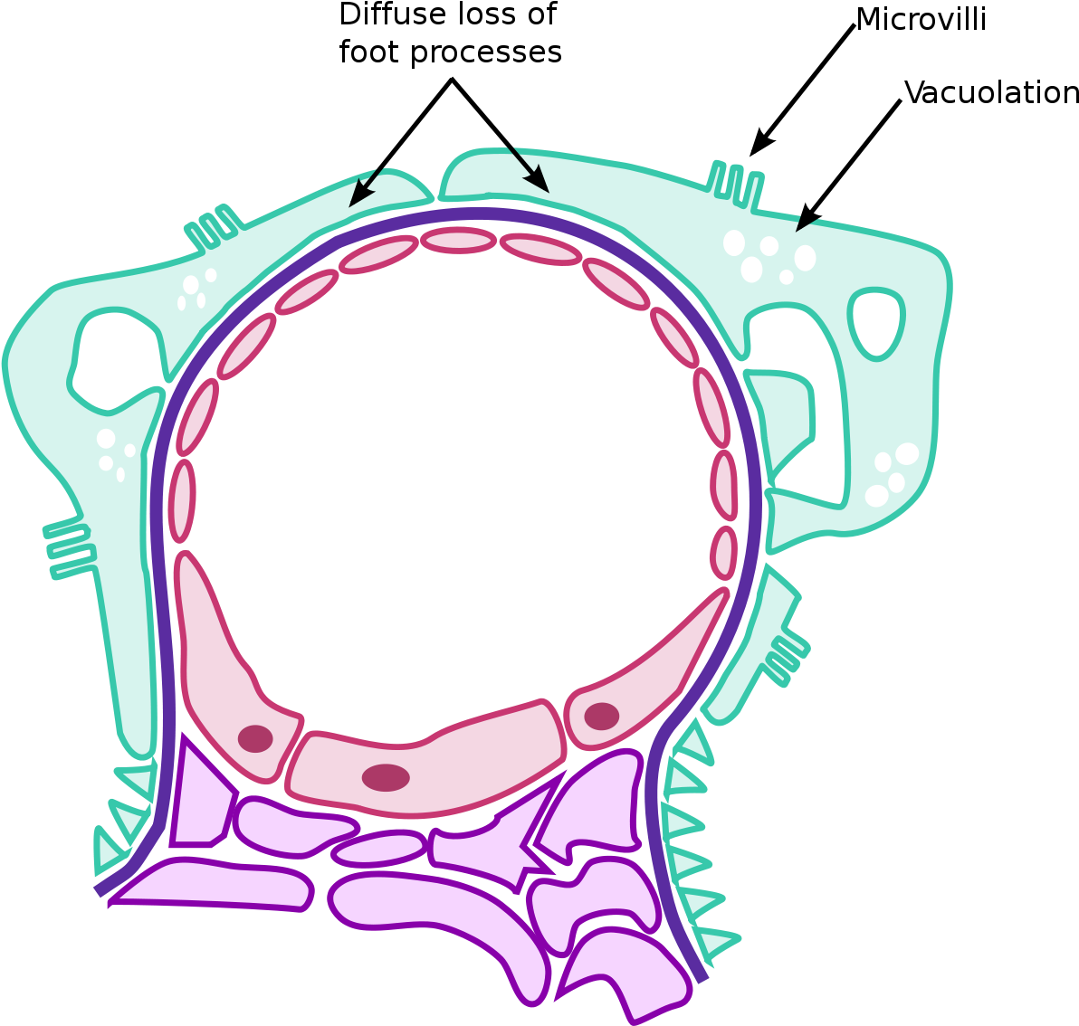 Minimal Change Nephrotic Syndrome (1200x1146)