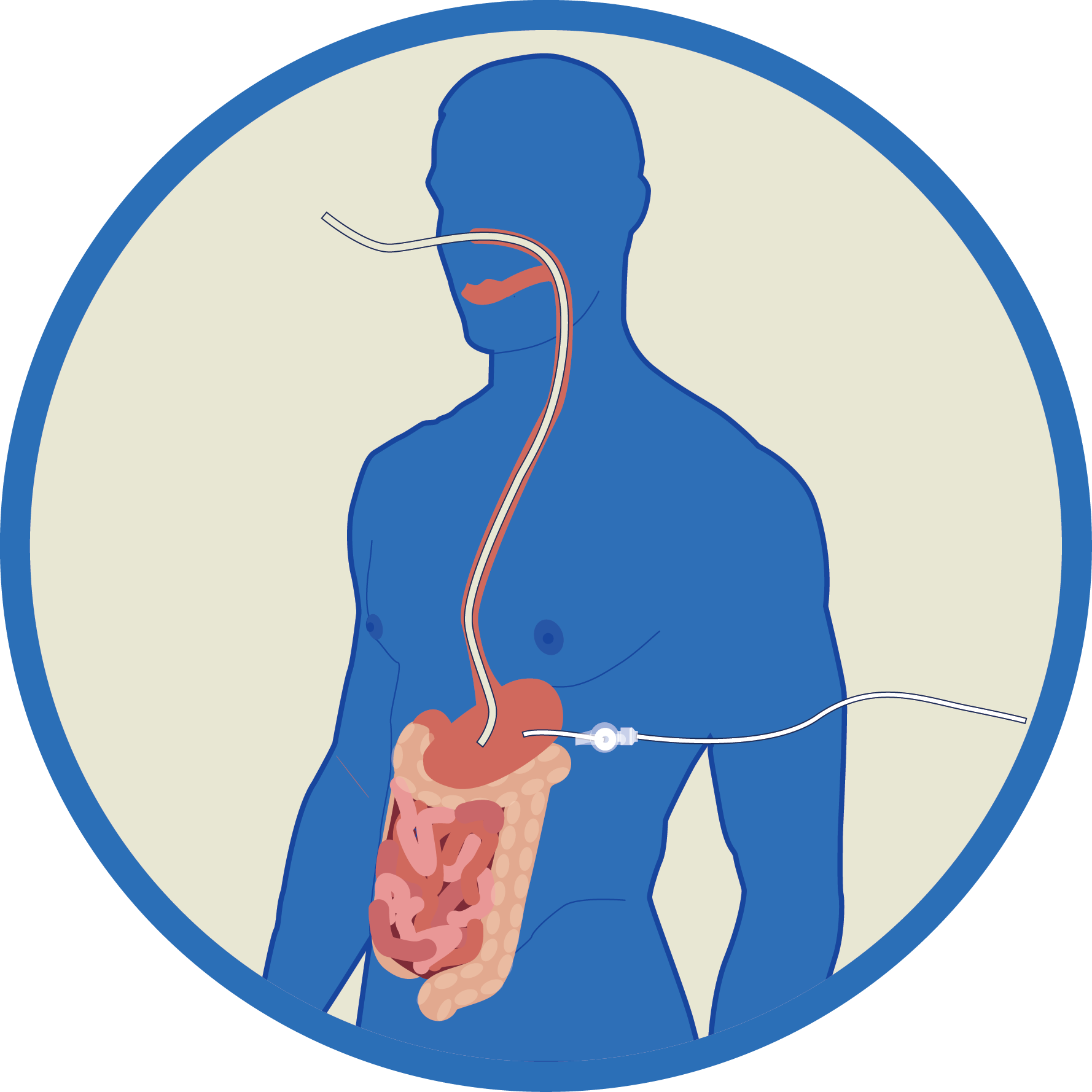 Enteral Tube Feeding Nasogastric , Nasojejunal (nj), - Danske Baptisters Spejderkorps (1778x1778)