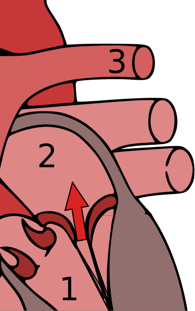 Mitral Valve Prolapse Can Result In Mitral Regurgitation, - Mitral Valve Prolapse (1200x1909)