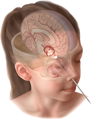 Endoscopic Endonasal Approach To Skull Base Tumors - Surgery (330x440)