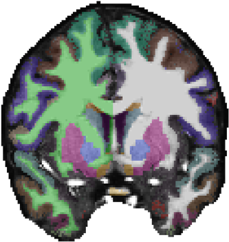 Brain With Schizophrenia Png (409x423)