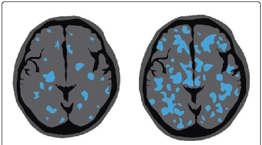 Modified From Suzuki [13] - Microglia (513x285)
