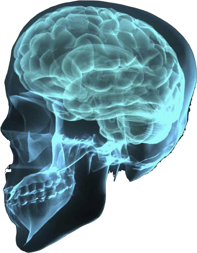 Skull Brain Cut Out Png - Back From Brain Aneurysm (943x1149)