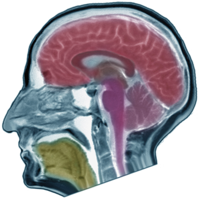 Frequently Asked Questions About Stroke - Illustration (400x401)