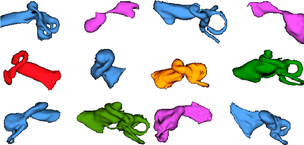Choosing Electrode Arrays For Cochlear Malformation - Electrode Array (1024x576)