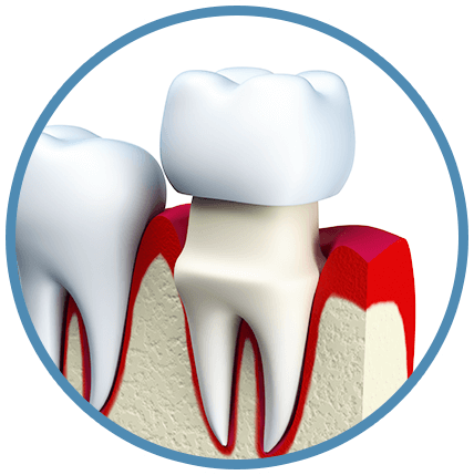 Dental Crowns - Dental Crown Png (428x429)