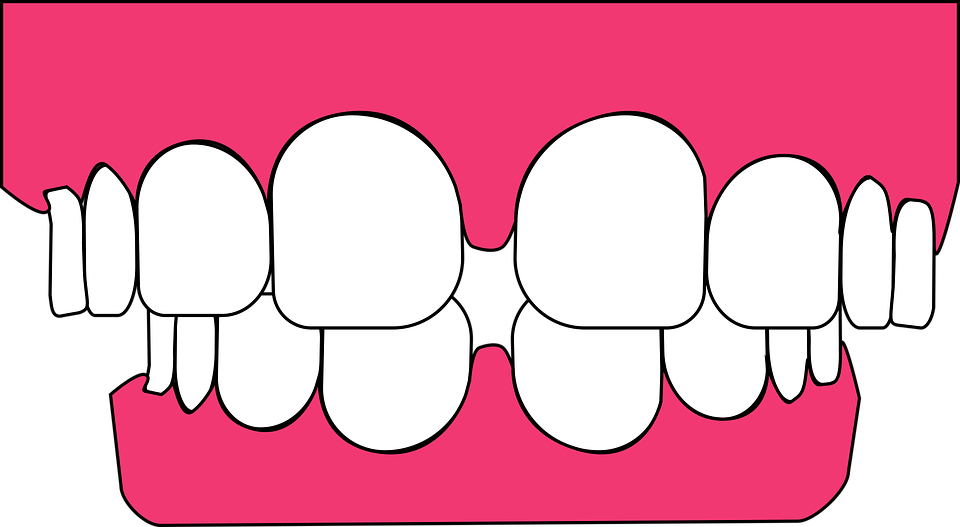 Jasper Ave Dental - Gums (960x527)
