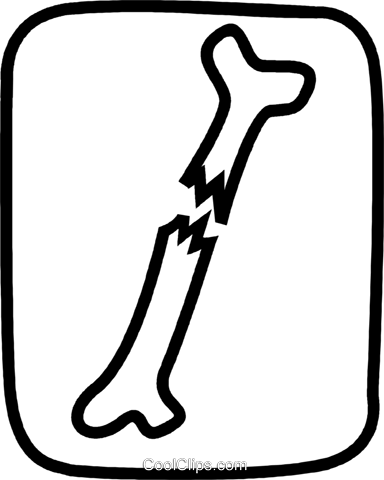 Broken Bone Royalty Free Vector Clip Art Illustration - Broken Bone Clip Art (384x480)