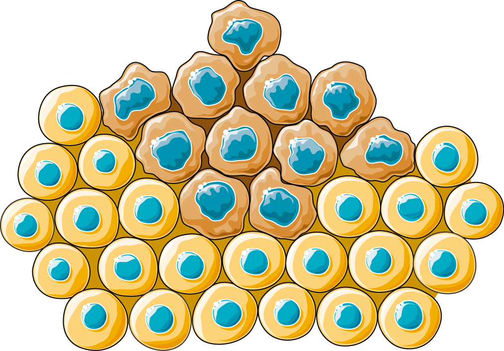 Carcinoma - Microbubbles Drug Delivery (1012x706)