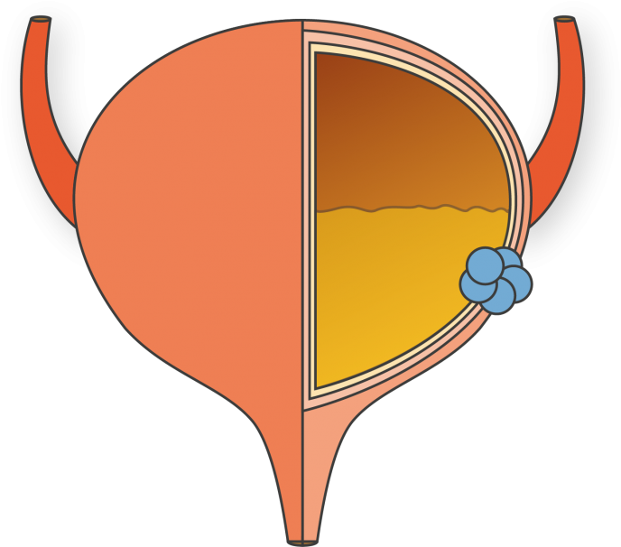About Bladder Cancer - Vejiga Png (725x629)