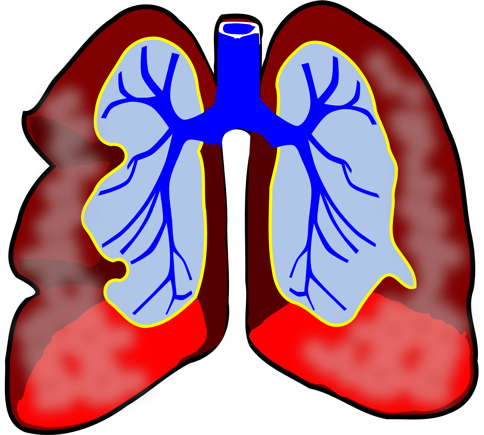 Respiratory Science, Diagram, Human, Air, System, Respiratory - Lung Cancer Clipart (1920x1713)