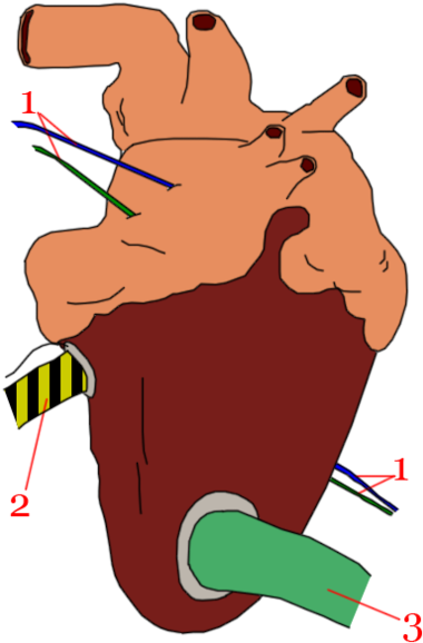 394px-coeur Auxiliaire - Warhammer 40k Space Marine Implants (394x599)