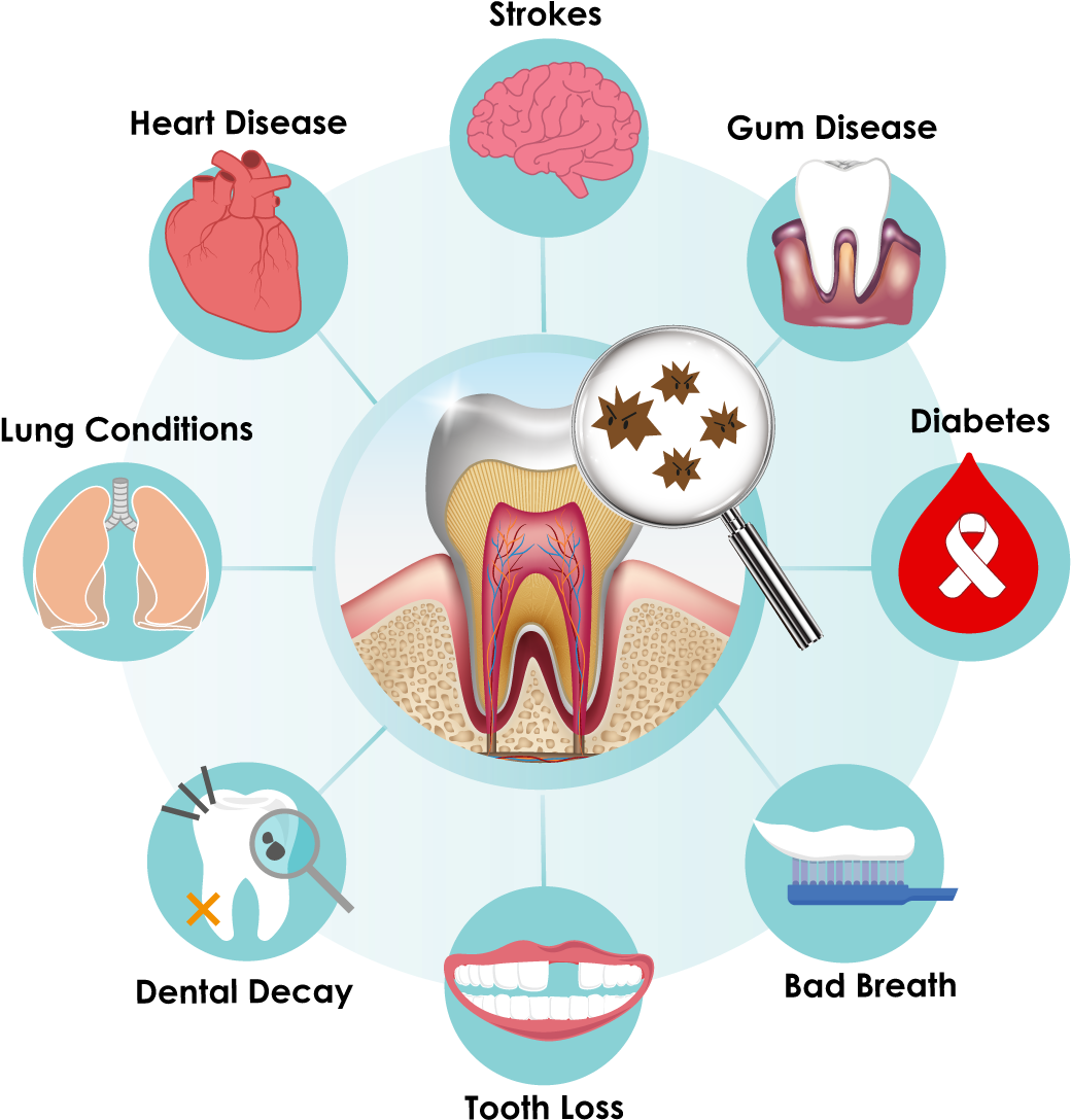 Decay Clipart Oral Health - Microbiota Oral (1333x1156)