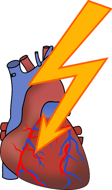 Health Arrhythmia, Heart Attack, Cardiac, Coronary, - Cardiac Arrhythmia Clip Art (377x640)