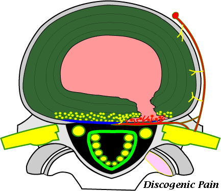 If Every Single Person's Discs Start To Dehydrate And - Exiting And Traversing Nerve Root (433x373)