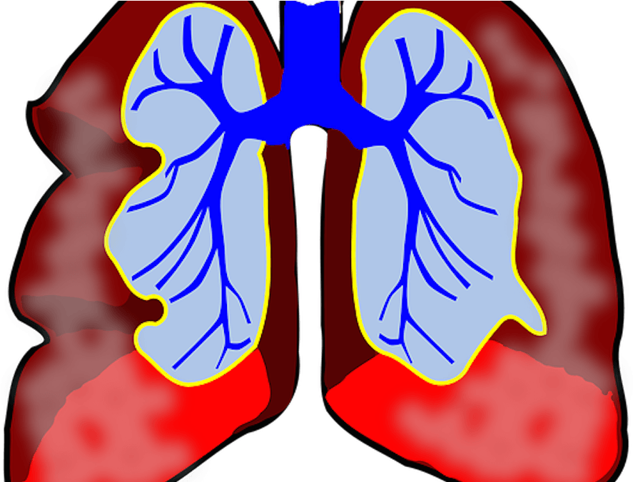 Allergic Asthma Signs Symptoms And Treatments - Lungs Clip Art (900x675)
