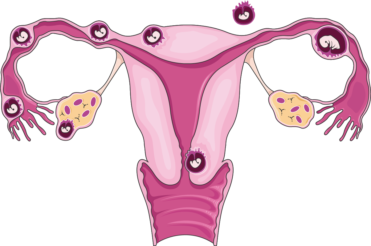 Ectopic Pregnancy - Ectopic Pregnancy (1204x798)