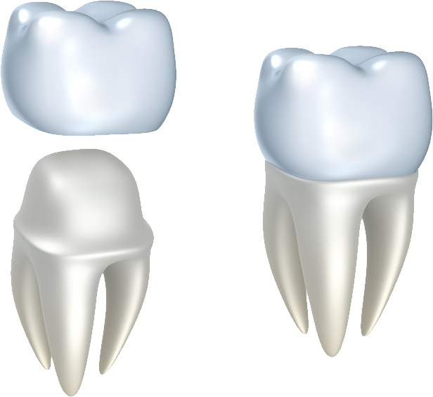 Restoring Your Smile - Dental Crowns Png (616x565)