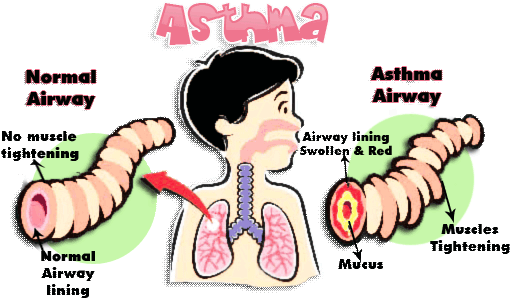 Treatment Clipart Asthma Attack - Omega 3 And Asthma (510x305)